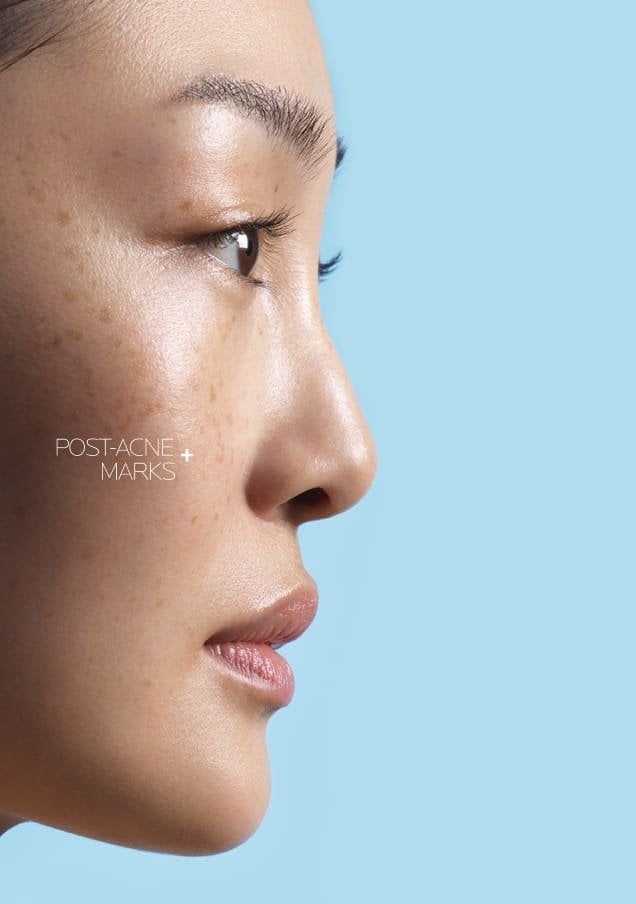 /-/media/project/loreal/brand-sites/lrp/emea/nordics/products/effaclar/effaclar-a-z-gel-cream/desktop/lrp-effaclar_azcream_flip_card_front_desktop_3.jpg